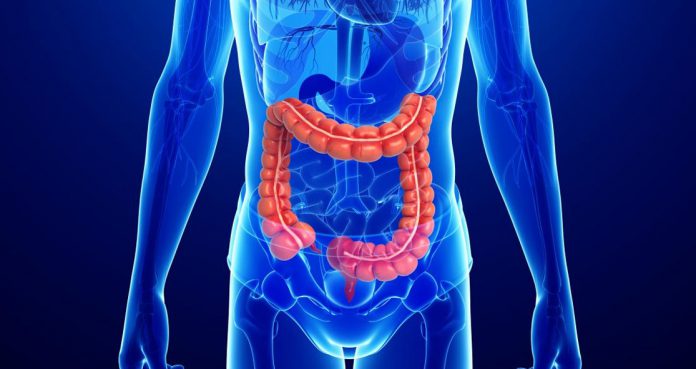 Early Onset Colon Cancer Greater Risk