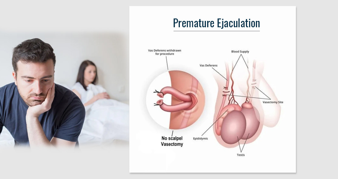 Premature Ejaculation Commercial