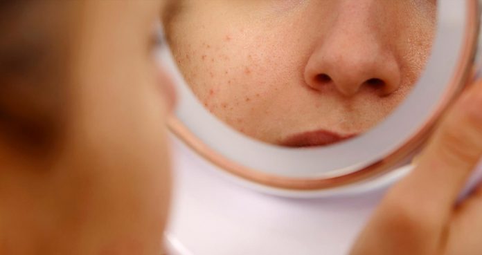 Researchers Identify Genetic Cause of Autoimmune Disease Lupus